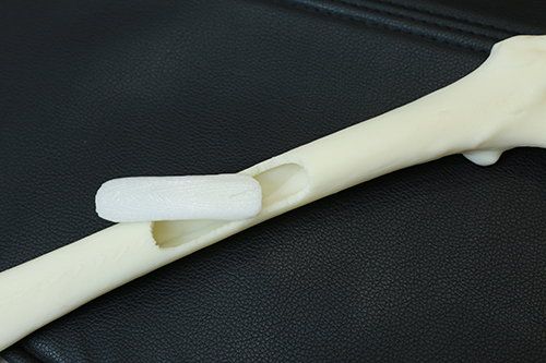 為病人度身打印仿骨,用以固定碎骨 為病人度身打印仿骨,用以固定碎骨
